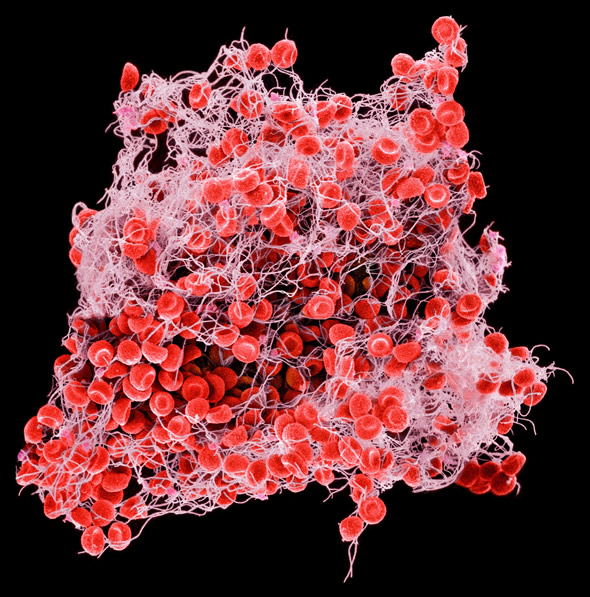 Coágulo sanguíneo mostrado por microscopia eletrônica.