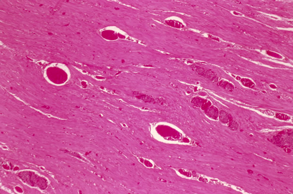Cromogranina A: marcador aumenta na presença de carcinoma de intestino, visto aqui por microscopia.